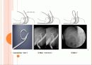 ERCP : 내시경적 역행성 췌담관 조영술 (Endoscopic retrograde cholangiopancreatography) 15페이지