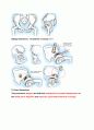 발달성 고관절 탈구 (CONGENITAL AND DEVELOPMENTAL DYSPLASIA OF THE HIP) 7페이지