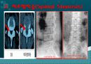 SCI(Spinal Cord Injury : 척수손상) 5페이지