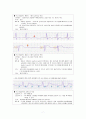 (성인간호학)부정맥의 기전, 종류, 심전도 모양(심실빈맥, 심실세동의 간호, 치료, 심전도 모양) 7페이지
