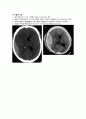 cerebral Hemorrhage 3페이지