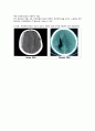 cerebral Hemorrhage 5페이지