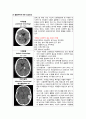 cerebral Hemorrhage 7페이지