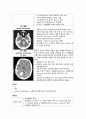 cerebral Hemorrhage 8페이지