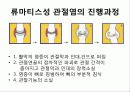 류마티스관절염 5페이지