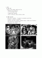 상염색체 우성 다낭신 4페이지