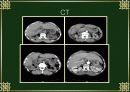 담낭염(cholecystitis)케이스 10페이지