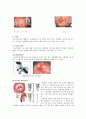 [모성간호학-환자사례 간호과정] 자궁경부 이형성증 (moderate cervical dysplasia) 케이스 19페이지
