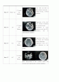 NSICU, T-SDH (Traumatic Subdural Hematoma), case 8페이지