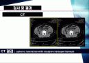 비장파열 (Ruptured spleen) 12페이지