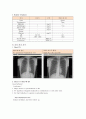 기흉환자간호 케이스 스터디 (spontaneous pneumothorax case study) 12페이지