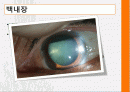 백내장환자의 인공수정체삽입술 2페이지