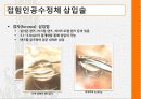 백내장환자의 인공수정체삽입술 4페이지