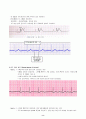부정맥(arrhythmia) 및 치료 9페이지