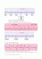 부정맥(arrhythmia) 및 치료 10페이지