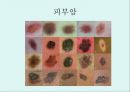[A+] 암의 예방과 정복 - 암의 유병율, 양성종양, 악성종양, 암의원인, 전파경로, 경고신호, 암의 종류, 위험요인, 예방법, 치료법, 올바른식사법, 유방암직장암결장암백혈병.ppt 25페이지