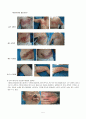 대상포진(Herpes zoster) Case study 5페이지