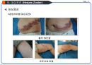대상포진(Herpes zoster) Case study.ppt 14페이지