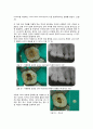 근관치료학 report 10페이지