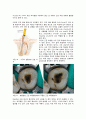 근관치료학 report 15페이지