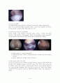 회전근개파열(Rotator cuff rupture)과 수술간호 18페이지
