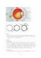 백내장수술(cataract extraction) 간호 4페이지