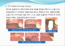 임플란트(Implant)와 관교의치의 개념 및 용어정리.ppt 19페이지