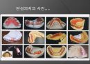 탄성국소의치(Flexible partial denture).ppt 19페이지