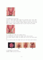 치질(Hemorroid) 6페이지