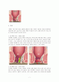 치질(Hemorroid) 7페이지