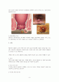 치질(Hemorroid) 8페이지