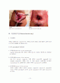 치질(Hemorroid) 12페이지