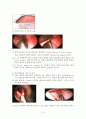 비중격만곡증(Nasal septal deviation)과 수술적 치료 12페이지
