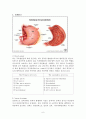 위암(Stomach cancer)과 위절제술(Gastrectomy) 6페이지