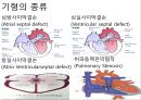 선천심장질환.ppt 3페이지