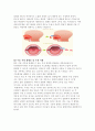 편도선절제술 9페이지