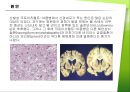 크로이츠펠트-야콥병 7페이지