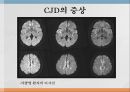 creutzfeldt-jacob disease 10페이지