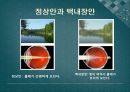 백내장과 녹내장.ppt 5페이지