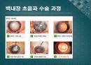 백내장과 녹내장.ppt 17페이지