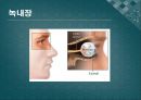백내장과 녹내장.ppt 22페이지