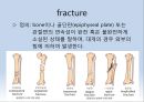Fx. TM,Ankle(삼과골절).ppt 5페이지