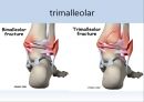 Fx. TM,Ankle(삼과골절).ppt 14페이지