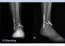 Fx. TM,Ankle(삼과골절).ppt 21페이지