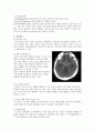 [Conference] 지주막하 출혈 Subarachnoid Hemorrhage , SAH  4페이지