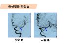 당뇨병과 당뇨합병증, 급성합병증, 만성합병증, 합병증관리 및 치료20130603 (1) 39페이지