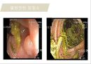대장암, 대장내시경, 대장암치료20130524 21페이지