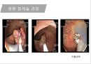 대장암, 대장내시경, 대장암치료20130524 31페이지