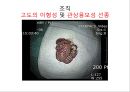 대장암, 대장내시경, 대장암치료20130524 32페이지