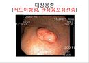 대장암, 대장내시경, 대장암치료20130524 33페이지